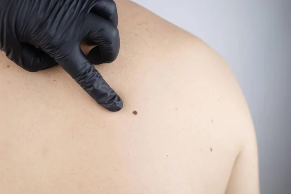 Homem Uma Consulta Dermatologista Mostra Suas Marcas Nascença Toupeiras Nevos — Fotografia de Stock