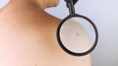 Dermatolog randevusundaki bir adam doğum lekelerini, benlerini ve nevi 'sini gösterir. Doktor dermatoskopla hastayı muayene ediyor. İyi huylu ve kötü huylu doğum lekeleri. Deri anormallikleri bakım konsepti