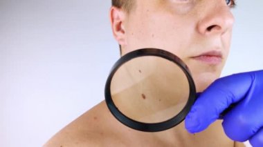 Dermatolog randevusundaki bir adam doğum lekelerini, benlerini ve nevi 'sini gösterir. Doktor dermatoskopla hastayı muayene ediyor. İyi huylu ve kötü huylu doğum lekeleri. Deri anormallikleri bakım konsepti