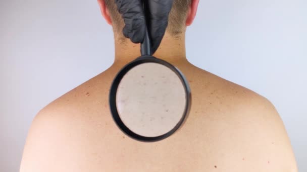 在皮肤科医生的预约中 一个男人展示了他的胎记 痣和痣 医生用皮肤镜检查病人 良性和恶性胎记 皮肤病护理概念 — 图库视频影像