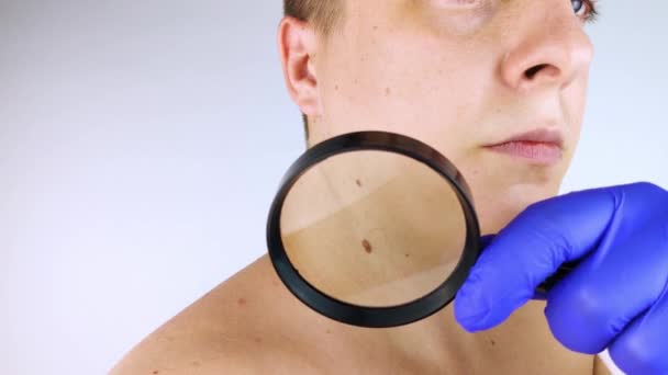 Dermatolog Randevusundaki Bir Adam Doğum Lekelerini Benlerini Nevi Sini Gösterir — Stok video