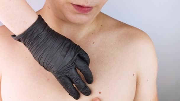 Man Dermatologist Appointment Shows His Birthmarks Moles Nevi Doctor Examines — Stock Video