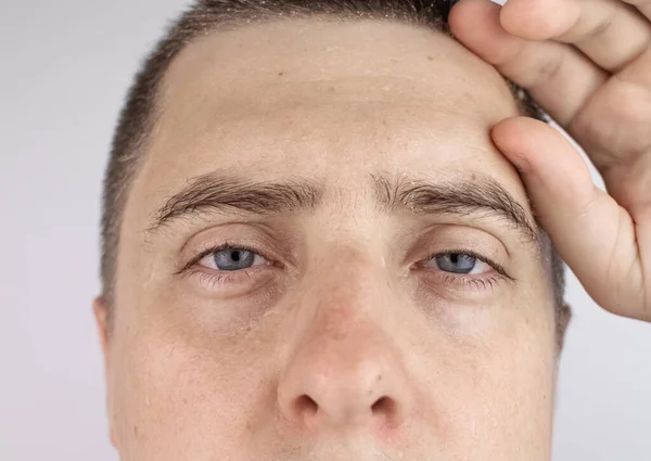 Hombre Con Sudor Cara Está Mirando Cámara Problemas Glándulas Sudoríparas — Foto de Stock