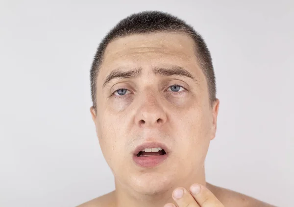 一个满脸汗珠的男人在看着摄像机 汗腺问题 多汗症 增加出汗 多汗症 对违反分泌机制行为的处理概念 — 图库照片