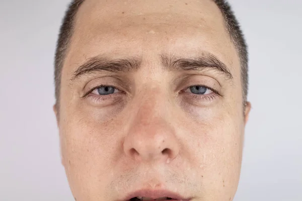 A man with sweating on his face is looking at the camera. Sweat gland problems. Hyperhidrosis, increased sweating, anhidrosis. The concept of treatment for violations of the mechanisms of secretion.