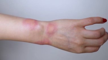 Görünür kızarıklık, iltihap ve böcek ısırığı ya da alerjik reaksiyondan kaynaklanan deri tahrişi olan şişmiş bir bileğin yakın çekimi. Ellerinde kızarıklık, kaşıntı ve yerel acı belirtileri var. Sivrisinek ısırığı, arı sokması ya da böcek ısırığı gibi..