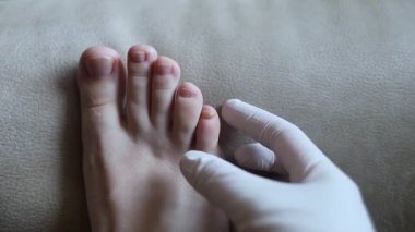 Hasarlı insan tırnaklarının yakın çekimlerinde renk değişimi, kalınlaşma ve ayrılma görülüyor. Onikomikoz, onikositoz, hiperkeratoz, tırnak mantarı, kromonizi, mantar enfeksiyonu ve tırnak sağlığı sorunları kavramı..