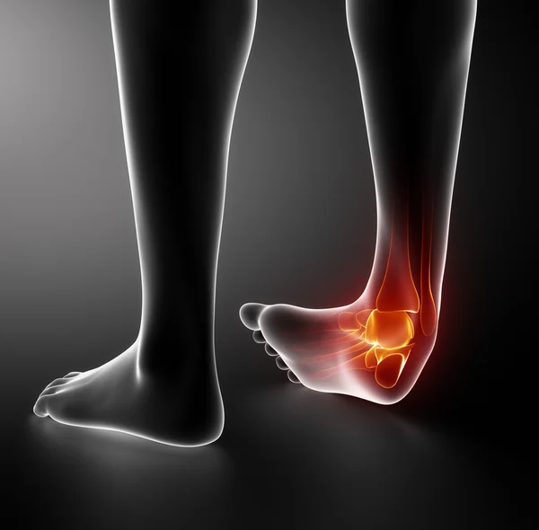 Sprained ankle — Stock Photo, Image