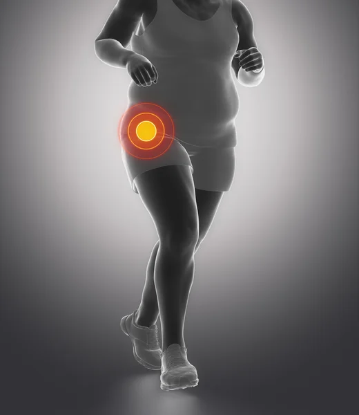 Obesity man with hip joint injury — Stock Photo, Image