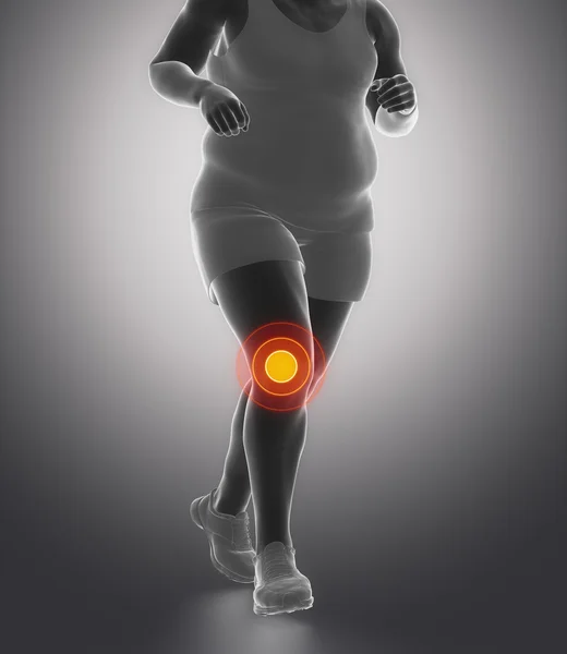 Obesity knee joint with ache — Stock Photo, Image