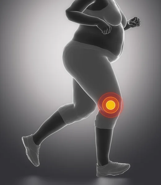 Homem de obesidade com problema no joelho — Fotografia de Stock