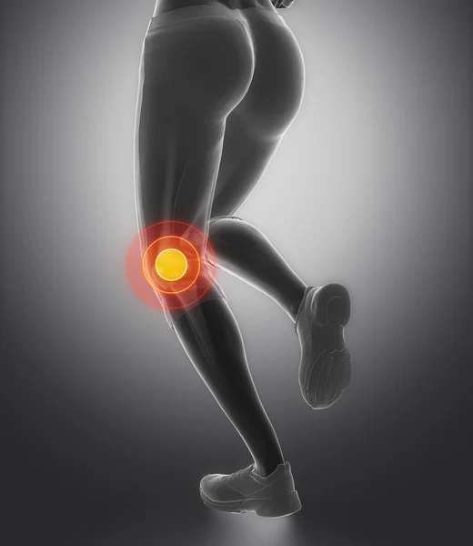 Knee and meniscus in sports injuries — Stock Photo, Image