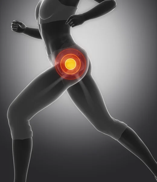 Hip in sports injuries — 图库照片