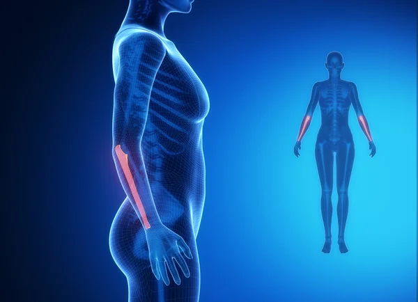 Kvinnliga kroppen med Ulna skelettscintigrafi — Stockfoto