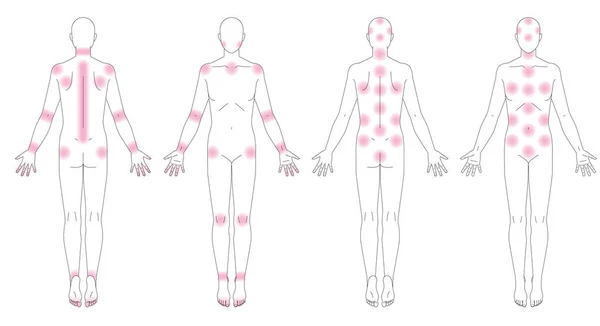 Människokroppen Platser Där Smärta Uppstår Schematisk Diagram Utan Kön — Stock vektor