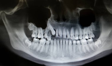 Diş röntgeni ve diş teli. Ortomografi, OPG X-ray dijital gençlik dişleri