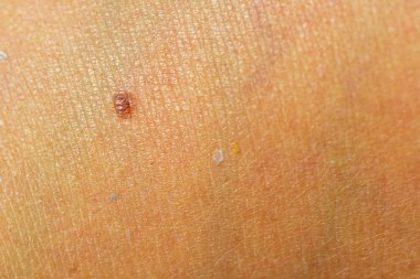 Güzellik beni çil fleck tabaklanmış insan deri detay