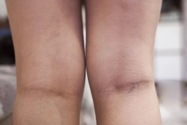 The initial stage of varicose veins, pain in the legs