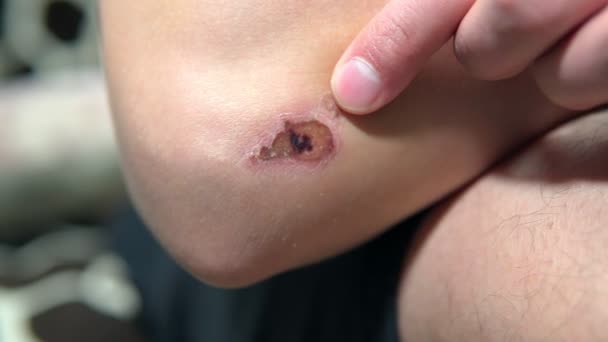 Djupa repor på huden med blåmärken på armbågen. närbild selektiv inriktning — Stockvideo
