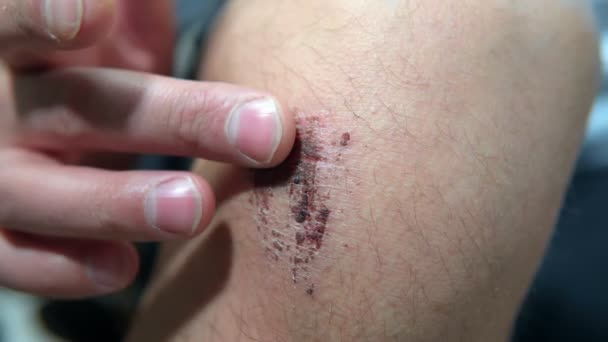 Deep scratches on the skin with bruises on knee. close-up selective focus — Stock Video