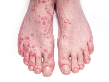 Deri bozuklukları kurdeşen gibi. Beyaz lekeli insan bacakları..