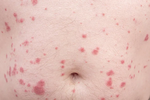 Close-up of skin disorder as hives or allergy. Human body with rash