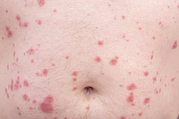 Close-up of skin disorder as hives or allergy. Human body with rash