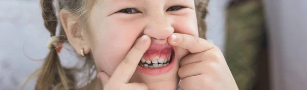 Dientes Permanentes Para Adultos Delante Los Dientes Leche Del Niño — Foto de Stock