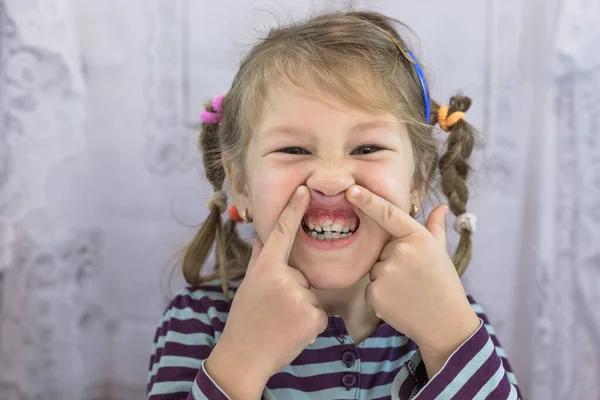 Dientes Permanentes Para Adultos Delante Los Dientes Leche Del Niño —  Fotos de Stock