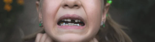 Dítě Zubní Ortodontickou Pomůckou Bez Jednoho Zubu — Stock fotografie