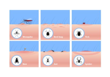 Böcek düz vektör çizimlerini ısırıyor. Sivrisinek kan içiyor, kene derinin altına giriyor, arı sokması. Tahtakurusu, karınca ve örümcek ısırıkları. Deri lezyonu, yara ve iltihap, alerjik reaksiyon..