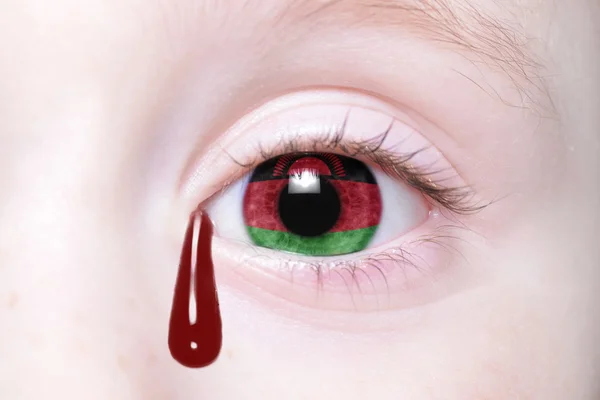 Ojo humano con bandera nacional de Malawi con lágrimas sangrientas — Foto de Stock