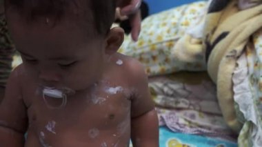 Tavuk Pox'u döküntü (Varisella) hastalığı