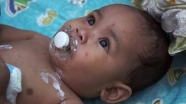Tavuk Pox'u döküntü (Varisella) hastalığı