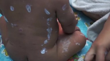 Tavuk Pox'u döküntü (Varisella) hastalığı