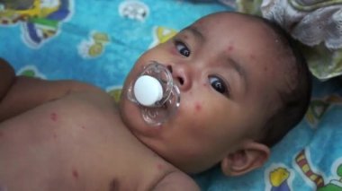 Tavuk Pox'u döküntü (Varisella) hastalığı