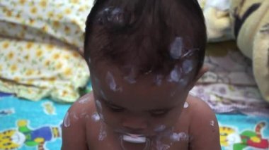 Tavuk Pox'u döküntü (Varisella) hastalığı