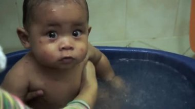 Tavuk Pox'u döküntü (Varisella) hastalığı