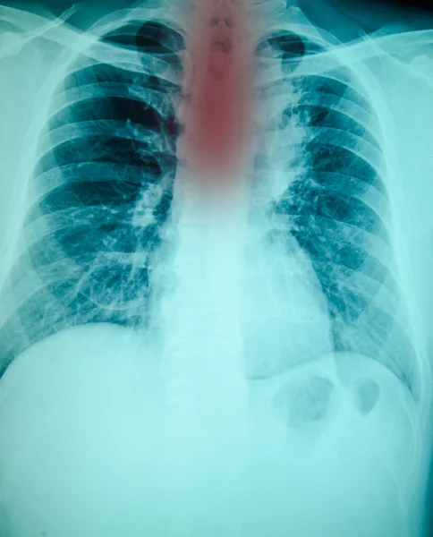 Røntgenbillede af brystkassen - Stock-foto