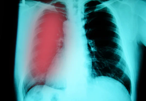 Chest  x-ray — Stock Photo, Image