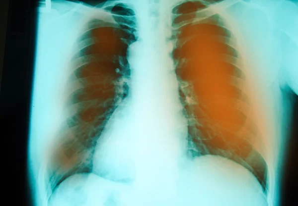 Chest  x-ray — Stock Photo, Image