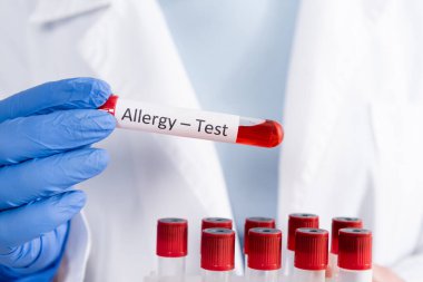 Alerji testi harfleriyle doktorun elinde tuttuğu tüpün görüntüsü. 