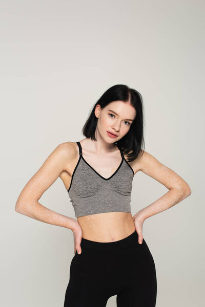 Sportswoman with vitiligo looking at camera isolated on grey 