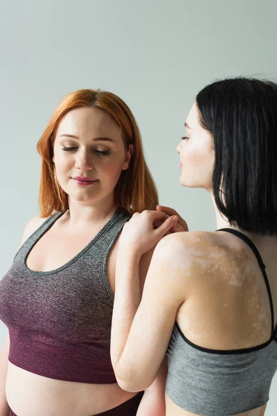 Jovem Mulher Com Vitiligo Abraço Mais Esportista Tamanho Isolado Cinza — Fotografia de Stock