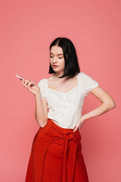 Mulher Morena Com Vitiligo Segurando Smartphone Isolado Rosa — Fotografia de Stock