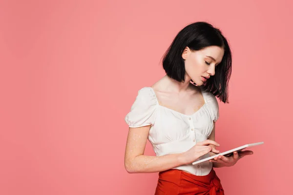 Mulher Moda Com Vitiligo Usando Tablet Digital Isolado Rosa — Fotografia de Stock