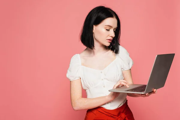 Joven Freelancer Con Vitiligo Usando Laptop Aislado Rosa — Foto de Stock