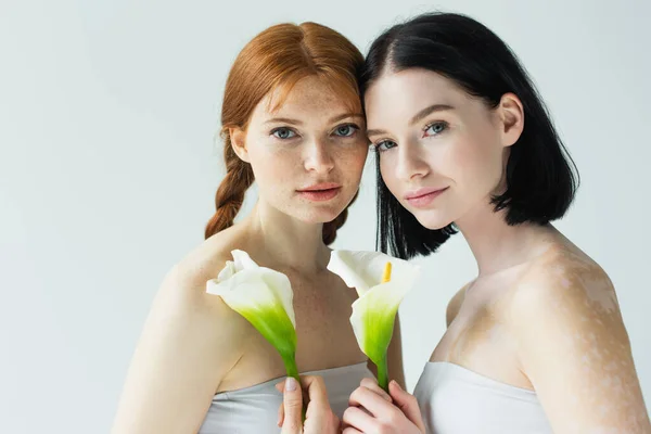 Body Positive Women Freckles Vitiligo Holding Flowers Isolated Grey — Stock Photo, Image