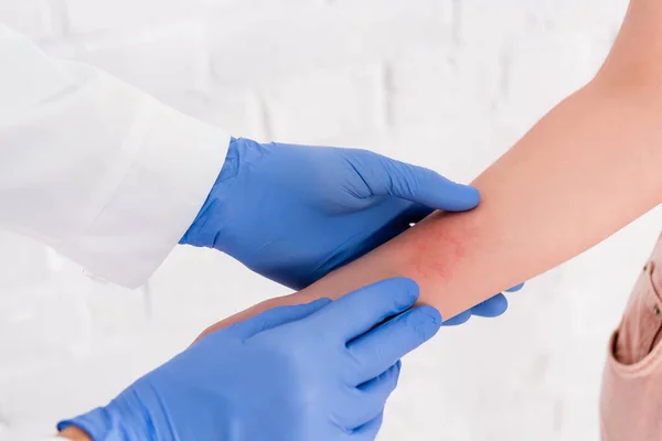 Vista recortada del médico que inspecciona el brazo de la mujer con alergia - foto de stock