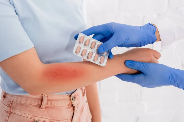 Vue recadrée du médecin dans des gants en latex tenant des pilules près de la femme avec une rougeur allergique sur le bras — Photo de stock